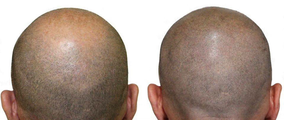 Hair micropigmentation
